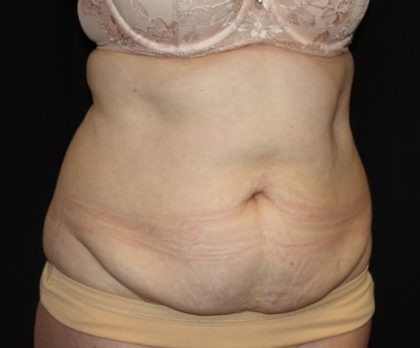 Tummy Tuck Before & After Patient #22791