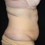 Tummy Tuck Before & After Patient #22791