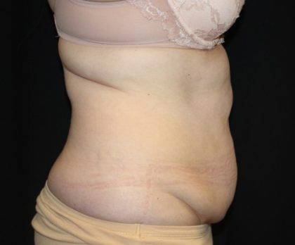 Tummy Tuck Before & After Patient #22791