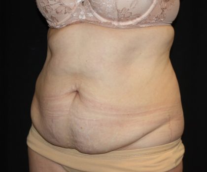 Tummy Tuck Before & After Patient #22791