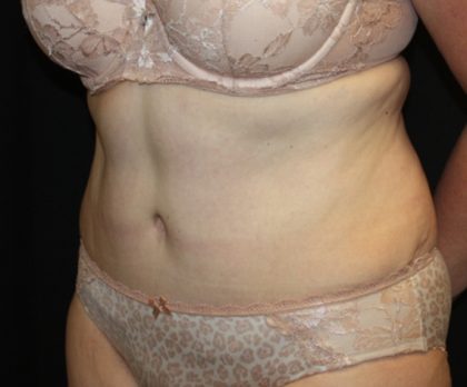 Tummy Tuck Before & After Patient #22791