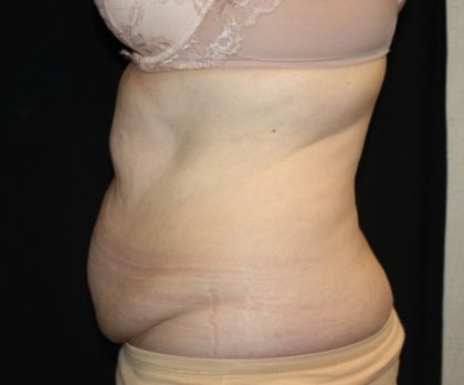 Tummy Tuck Before & After Patient #22791