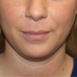 Kybella Before & After Patient #19798