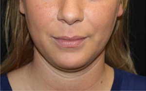 Kybella Before & After Patient #19798