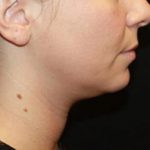 Kybella Before & After Patient #19798