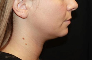 Kybella Before & After Patient #19798