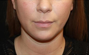 Kybella Before & After Patient #19798