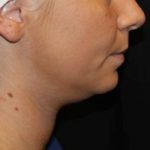 Kybella Before & After Patient #19798