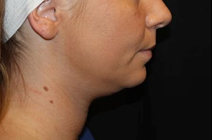 Kybella Before & After Patient #19798