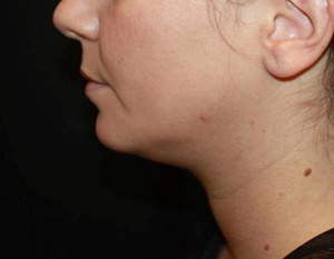 Kybella Before & After Patient #19798