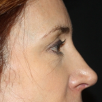 Brow Lift Before & After Patient #21114