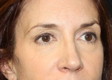 Brow Lift Before & After Patient #21114