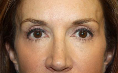 Brow Lift Before & After Patient #21114