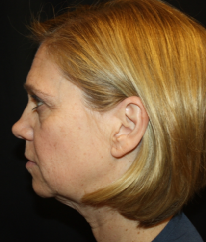 Facelift Before & After Patient #21159