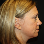 Facelift Before & After Patient #21159