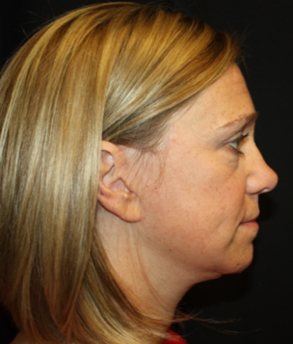 Facelift Before & After Patient #21159