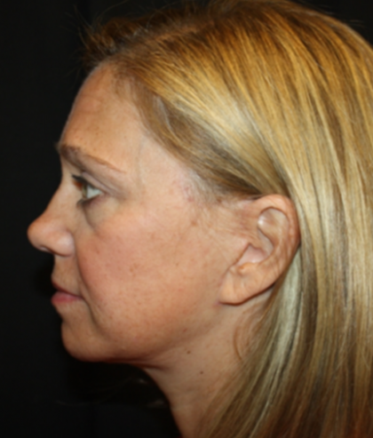 Facelift Before & After Patient #21159