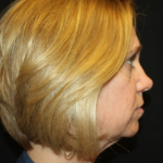 Facelift Before & After Patient #21159