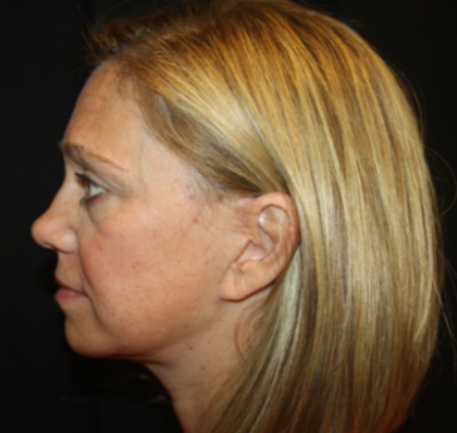 Brow Lift Before & After Patient #20302