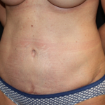 Tummy Tuck Before & After Patient #22775