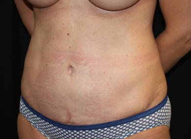 Tummy Tuck Before & After Patient #22775