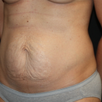 Tummy Tuck Before & After Patient #22775