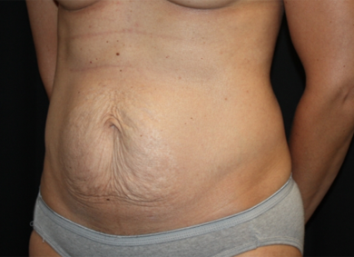 Tummy Tuck Before & After Patient #22775