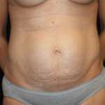 Tummy Tuck Before & After Patient #22775