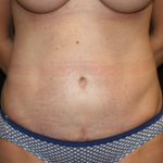 Tummy Tuck Before & After Patient #22775