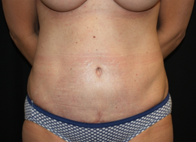 Tummy Tuck Before & After Patient #22775