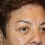 Blepharoplasty and Brow Lift Before & After Patient #20303