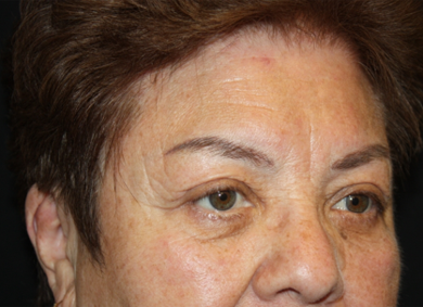 Blepharoplasty and Brow Lift Before & After Patient #20303