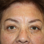 Blepharoplasty and Brow Lift Before & After Patient #20303