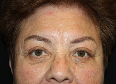 Blepharoplasty and Brow Lift Before & After Patient #20303