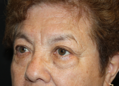 Blepharoplasty and Brow Lift Before & After Patient #20303