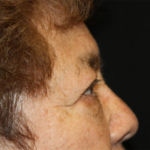 Blepharoplasty and Brow Lift Before & After Patient #20303
