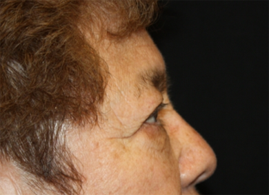 Blepharoplasty and Brow Lift Before & After Patient #20303