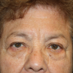 Blepharoplasty and Brow Lift Before & After Patient #20303