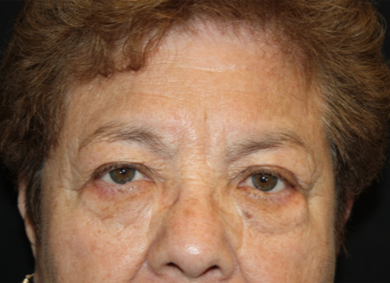 Blepharoplasty and Brow Lift Before & After Patient #20303