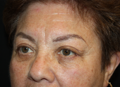 Blepharoplasty and Brow Lift Before & After Patient #20303