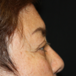 Blepharoplasty and Brow Lift Before & After Patient #20303