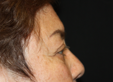 Blepharoplasty and Brow Lift Before & After Patient #20303