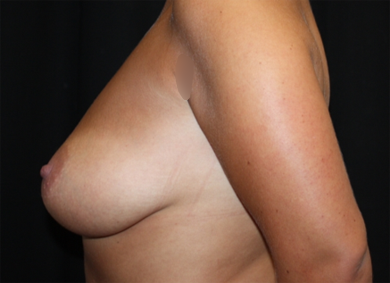 Breast Lift Before & After Patient #20978