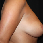Breast Lift Before & After Patient #20978