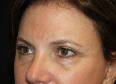Brow Lift Before & After Patient #21097