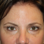 Brow Lift Before & After Patient #21097