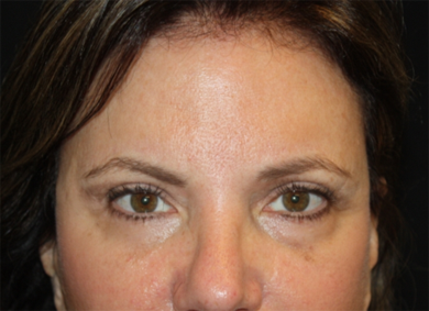 Brow Lift Before & After Patient #21097