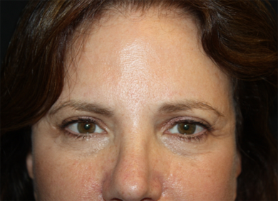 Brow Lift Before & After Patient #21097