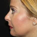 Kybella Before & After Patient #19809