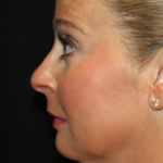 Kybella Before & After Patient #19809
